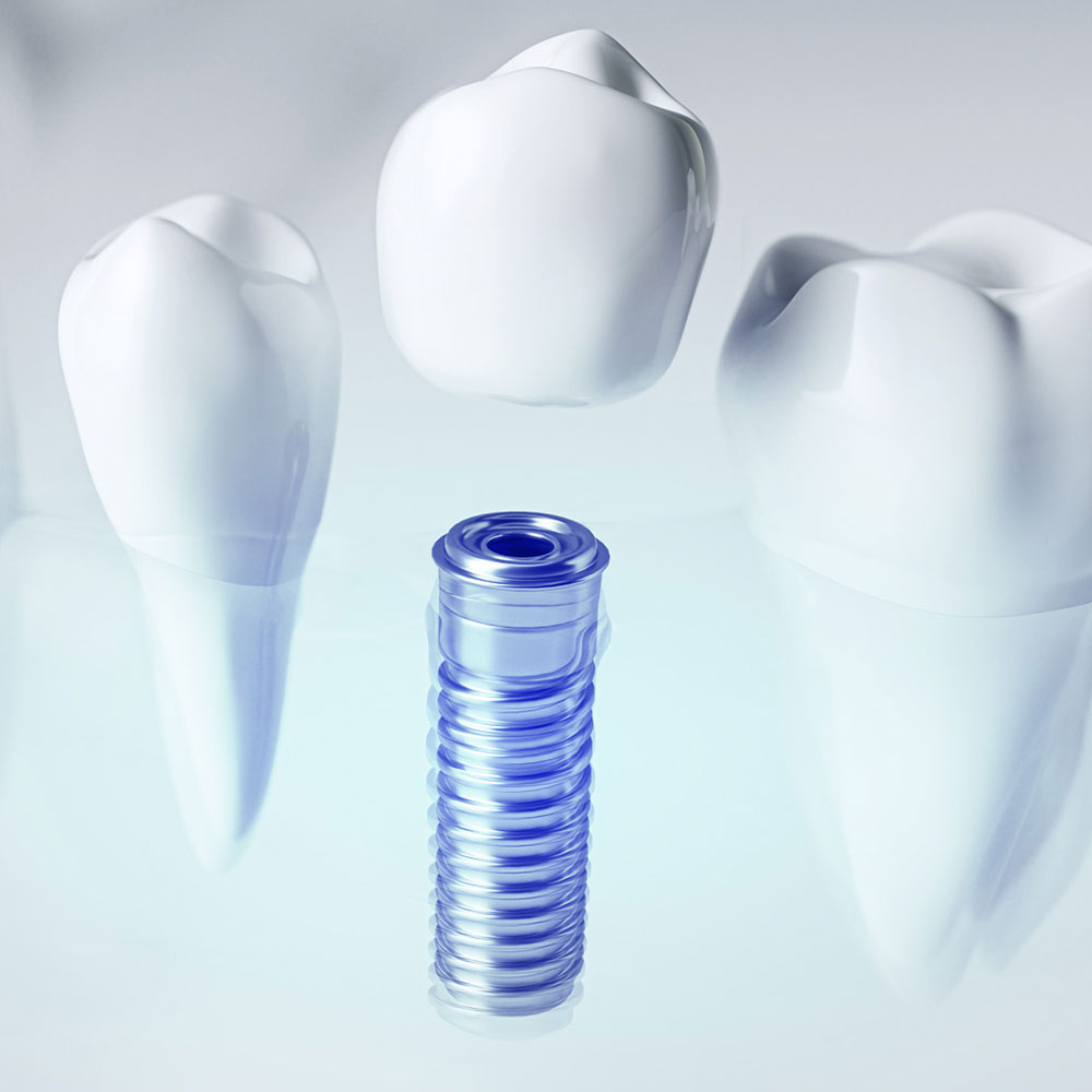 Implantes dentários