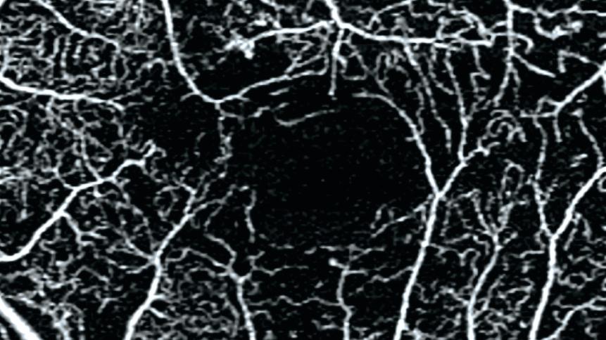 3x3 mm AngioPlex OCTA of proliferative diabetic retinopathy (PDR)