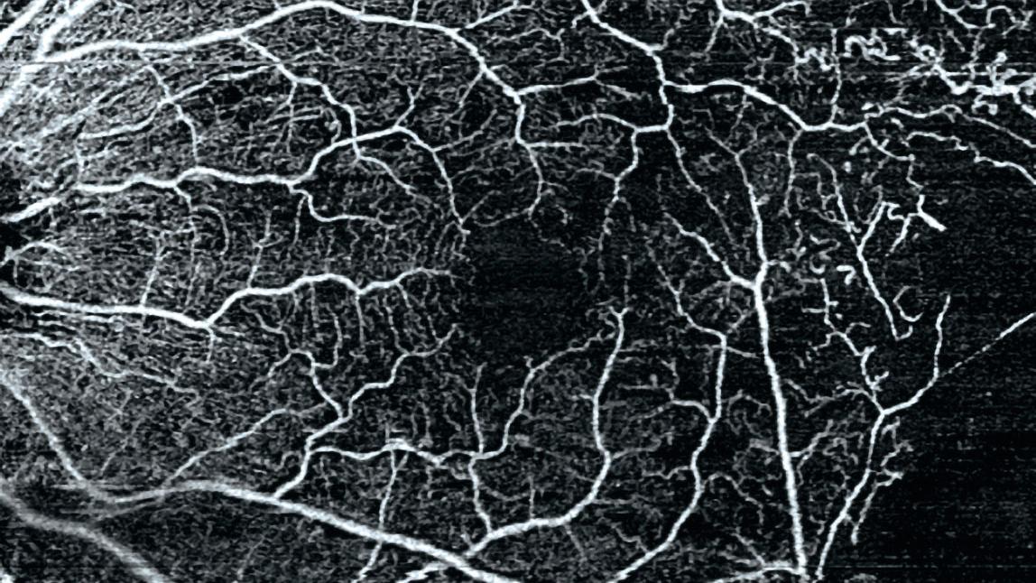 8x8 mm HD AngioPlex OCTA of BRVO.