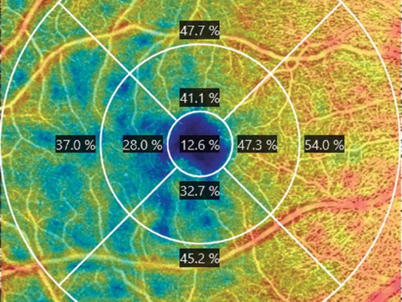 Gain new insights into glaucoma and retinal conditions