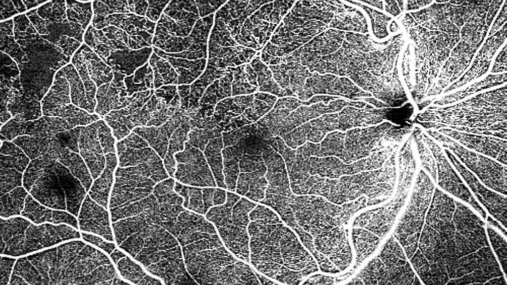 12x12 mm single-shot OCTA of branch retinal vein occlusion (BRVO)