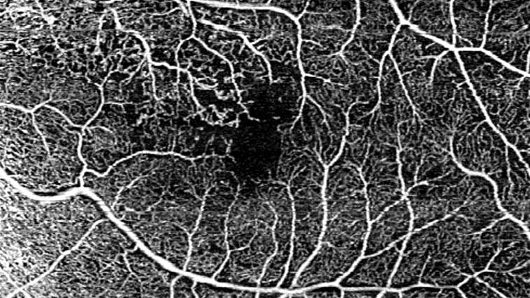 6x6 mm HD AngioPlex OCTA of non-proliferative diabetic retinopathy (NPDR)