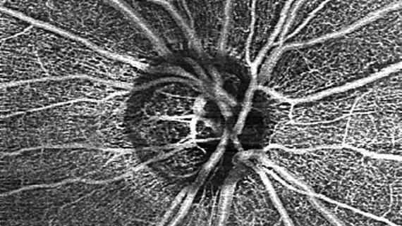 AngioPlex for ONH of an eye with advanced glaucoma