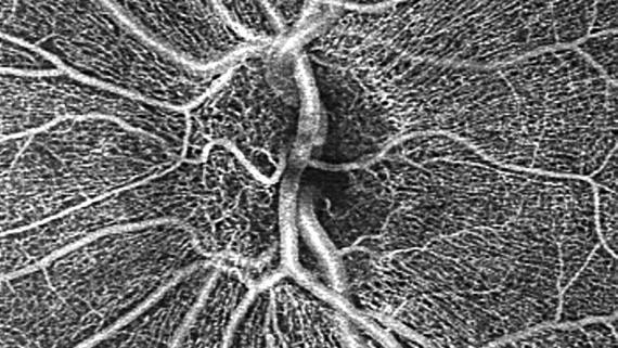AngioPlex for ONH of a normal eye