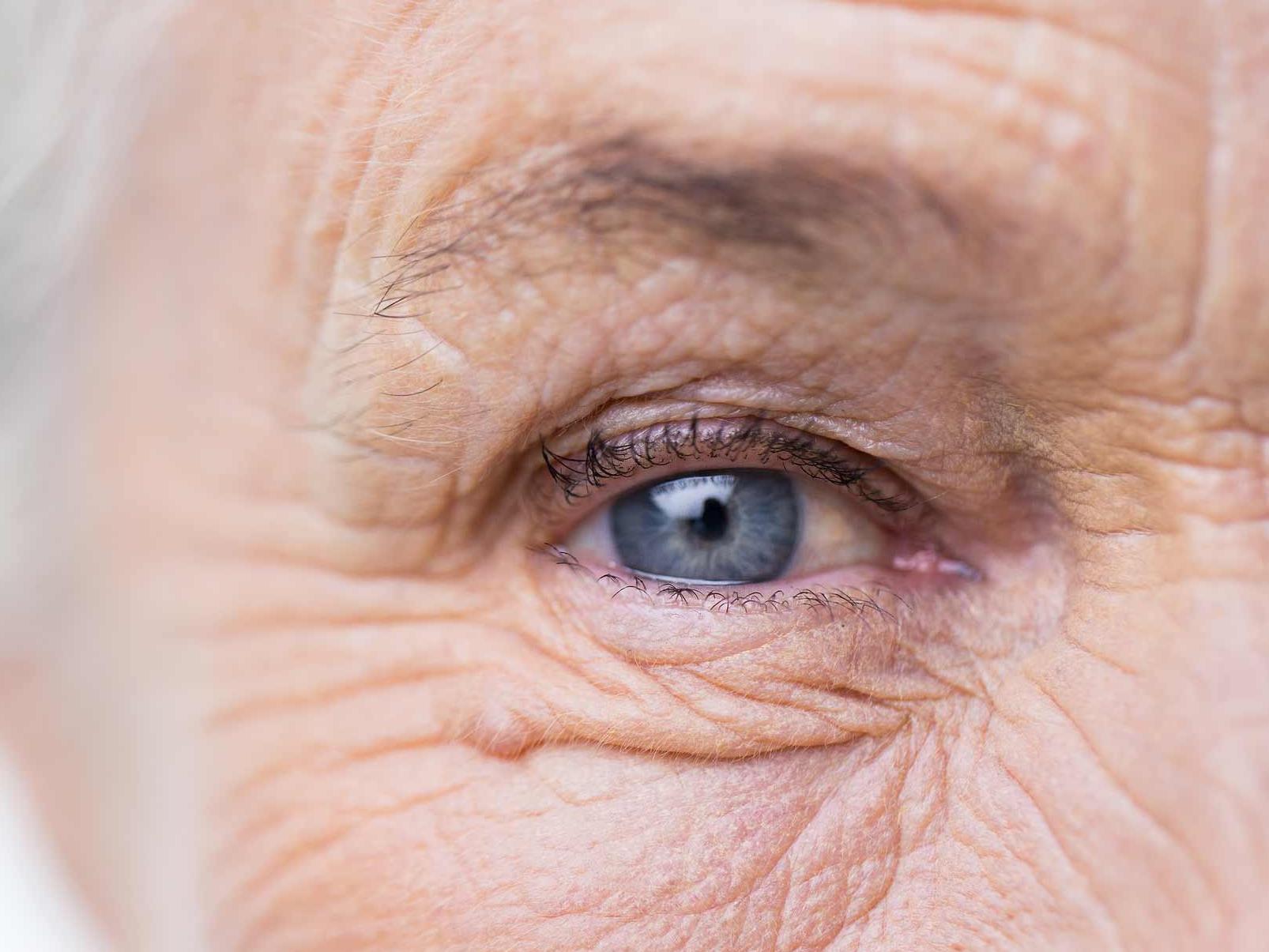 A imagem mostra um olho não saudável visto de perto, ilustrando o aspecto de possíveis danos oculares 