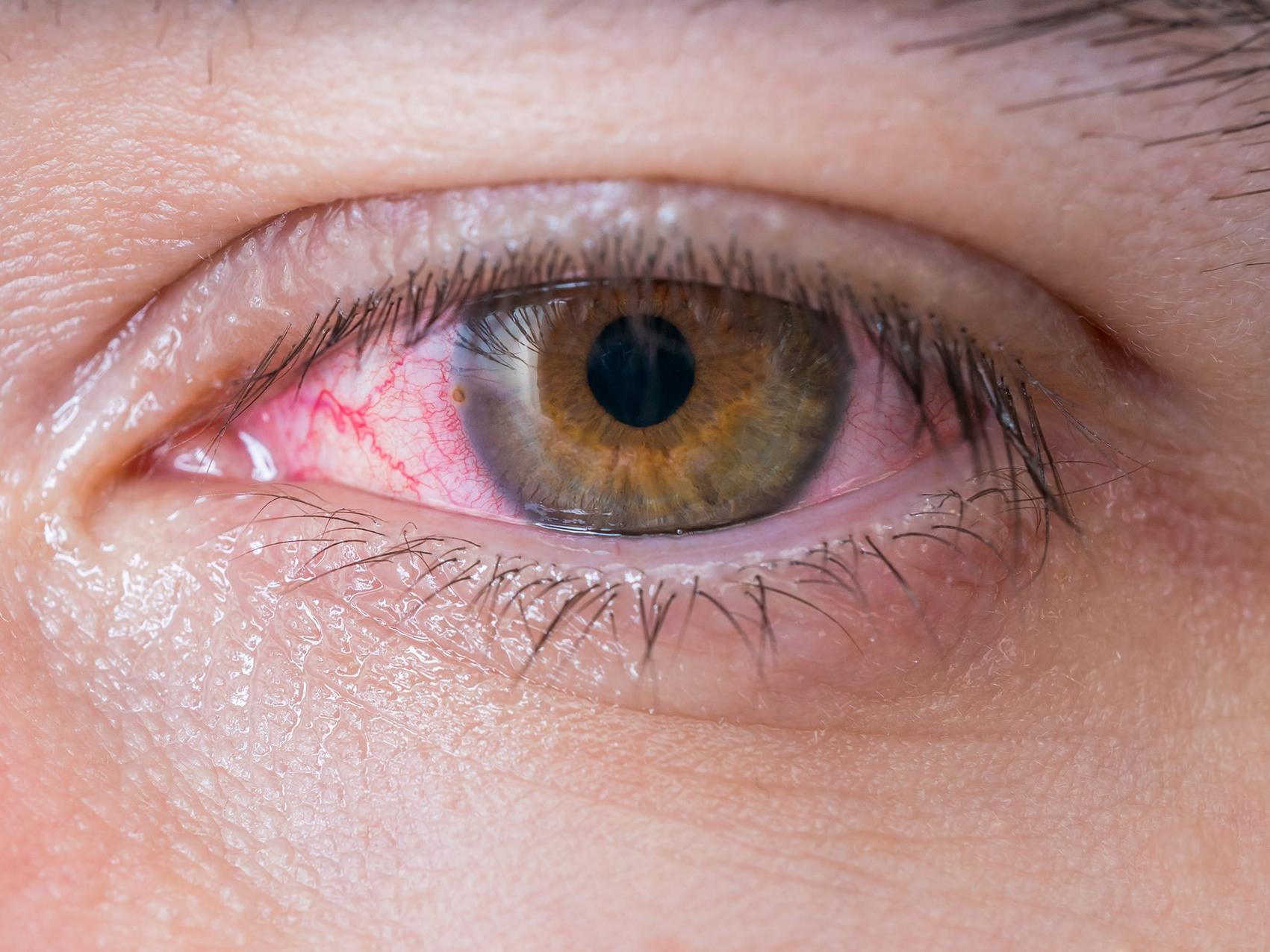 A imagem mostra um olho não saudável visto de perto, ilustrando o aspecto de possíveis danos visuais. 