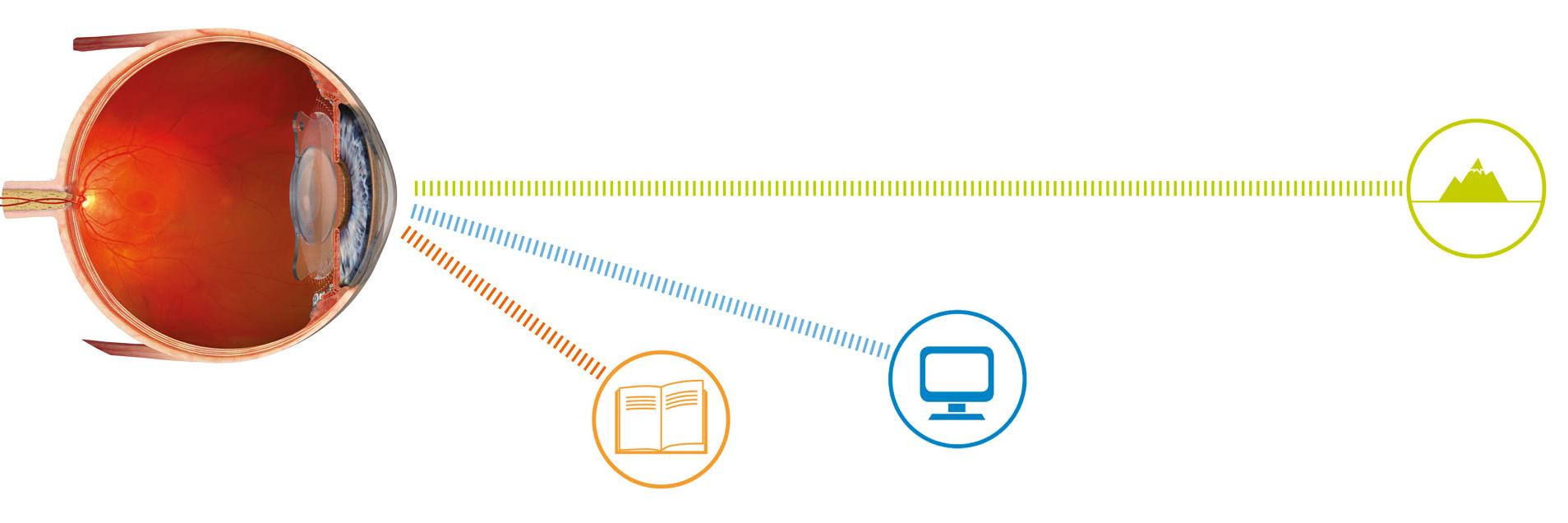 Diferentes distâncias de visão podem ser corrigidas com LIOs modernas