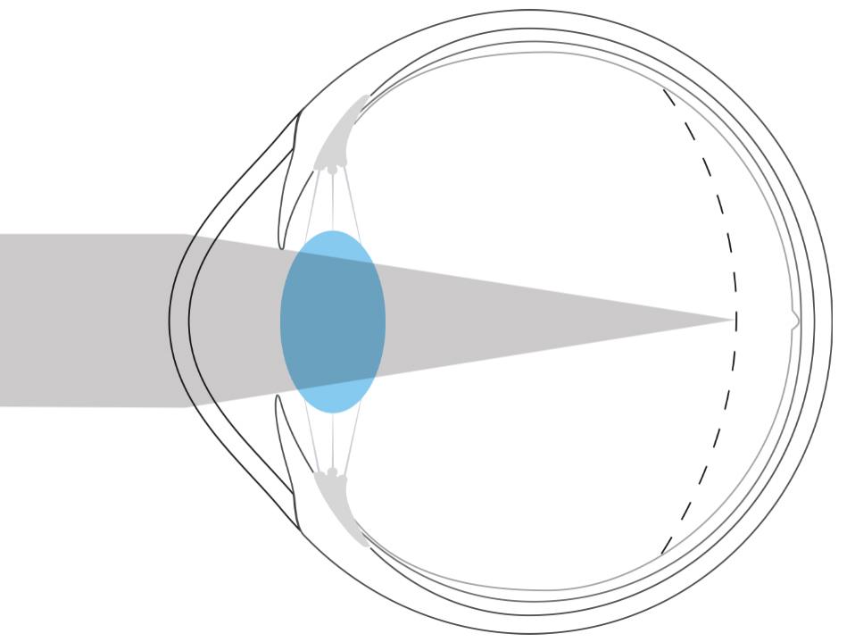 Ilustração de um olho míope mostrando que o foco da luz está na frente da retina.