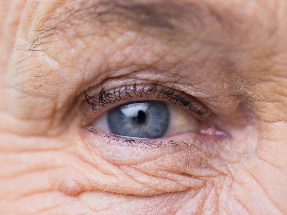 Imagem mostrando o fotoenvelhecimento em torno dos olhos.